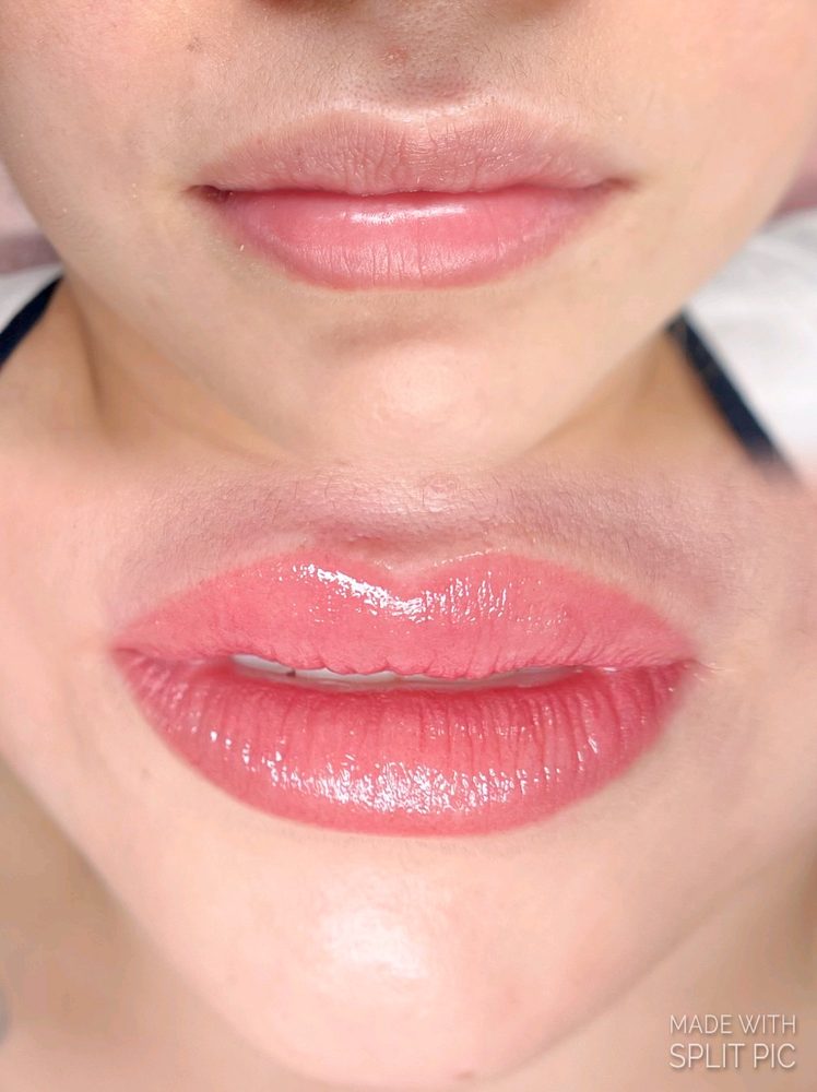 Protocolo Hidralips - hidratación de labios