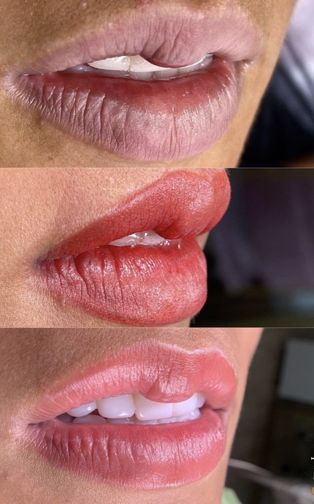 Neutralización de labios oscuros
